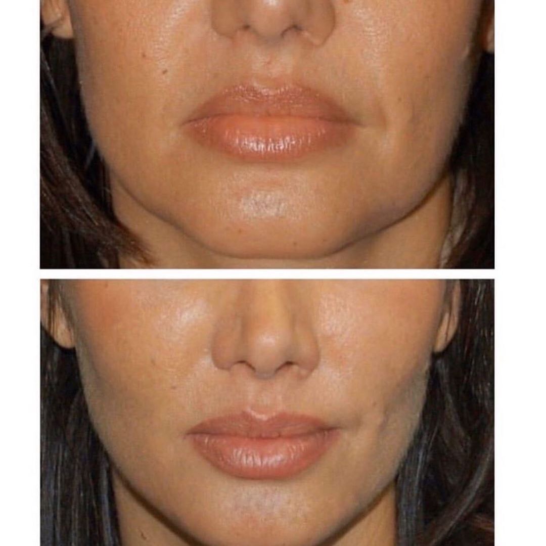 Требует ли красота жертв? Обсудили с пластическим хирургом Алексеем Филатовым бьюти-тренды и их побочные эффекты