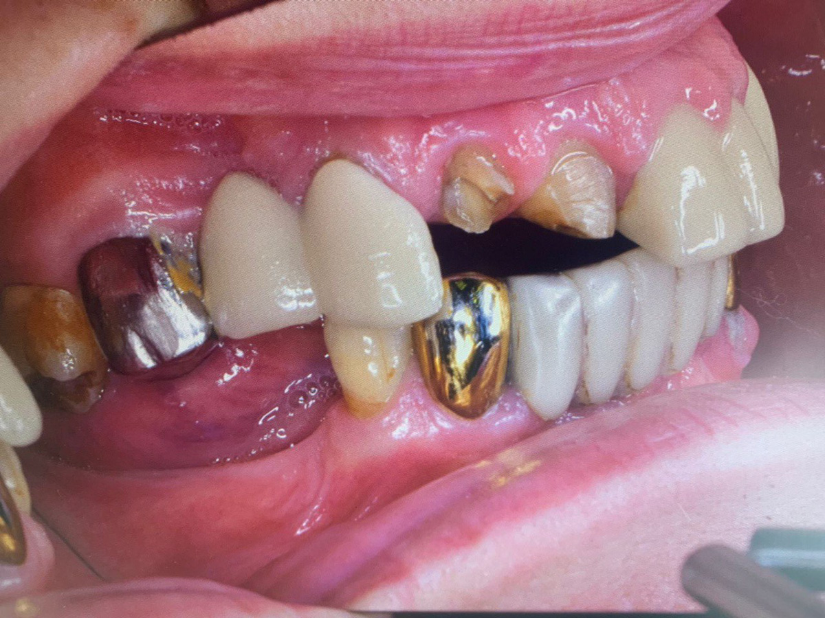 Начать новый год с новой белоснежной улыбкой — легко! Профессиональную помощь по обретению и восстановлению зубного ряда оказывают в «Лавиани». С «Ключ-Медиа» экспертным мнением на этот счет поделились врачи клиники — стоматолог-ортопед Никита Кадыков и хирург-имплантолог Алексей Комаров.