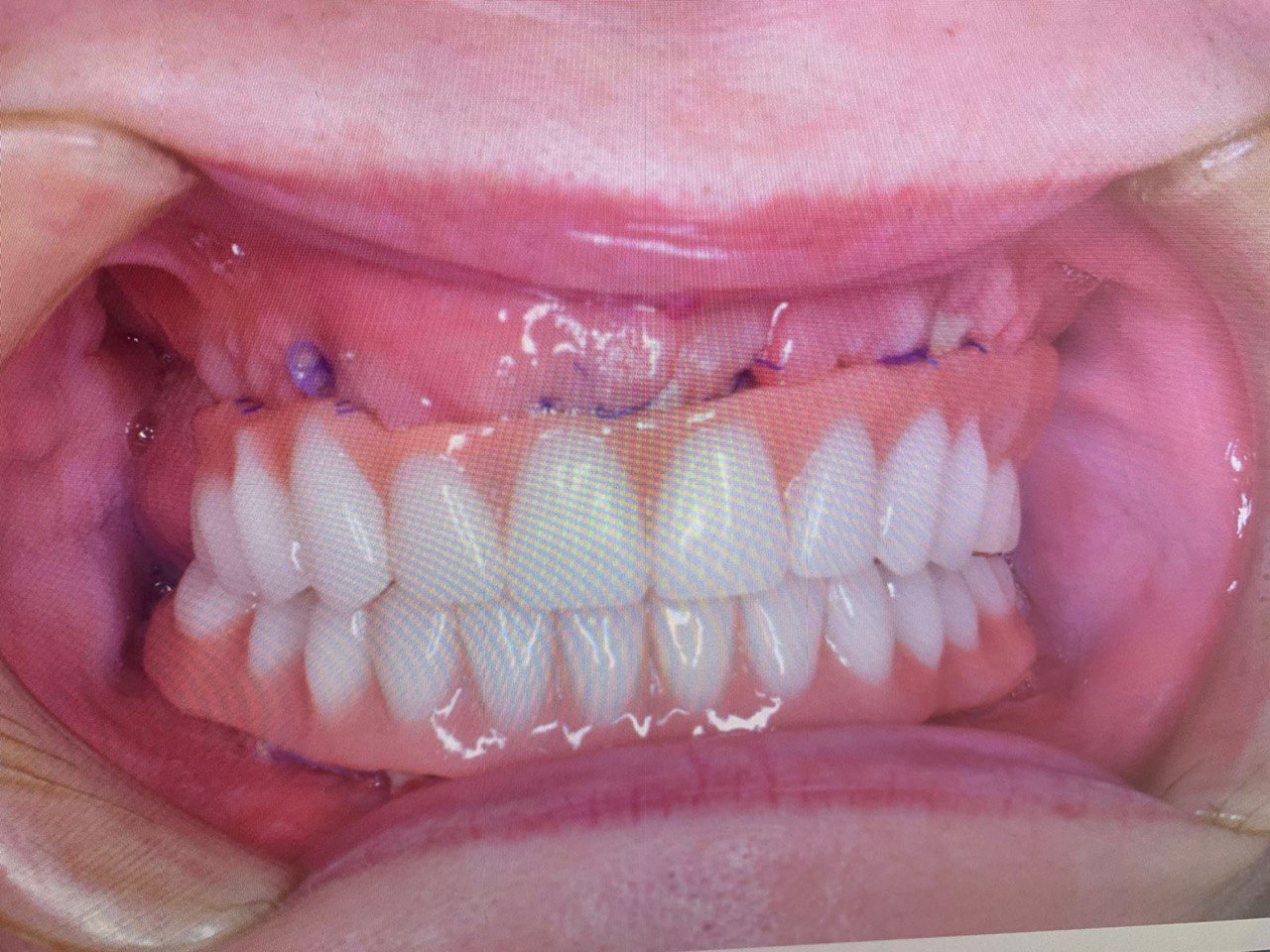 Начать новый год с новой белоснежной улыбкой — легко! Профессиональную помощь по обретению и восстановлению зубного ряда оказывают в «Лавиани». С «Ключ-Медиа» экспертным мнением на этот счет поделились врачи клиники — стоматолог-ортопед Никита Кадыков и хирург-имплантолог Алексей Комаров.