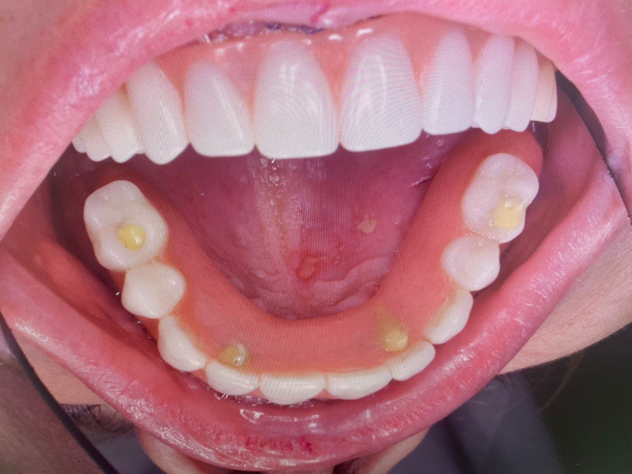 Начать новый год с новой белоснежной улыбкой — легко! Профессиональную помощь по обретению и восстановлению зубного ряда оказывают в «Лавиани». С «Ключ-Медиа» экспертным мнением на этот счет поделились врачи клиники — стоматолог-ортопед Никита Кадыков и хирург-имплантолог Алексей Комаров.